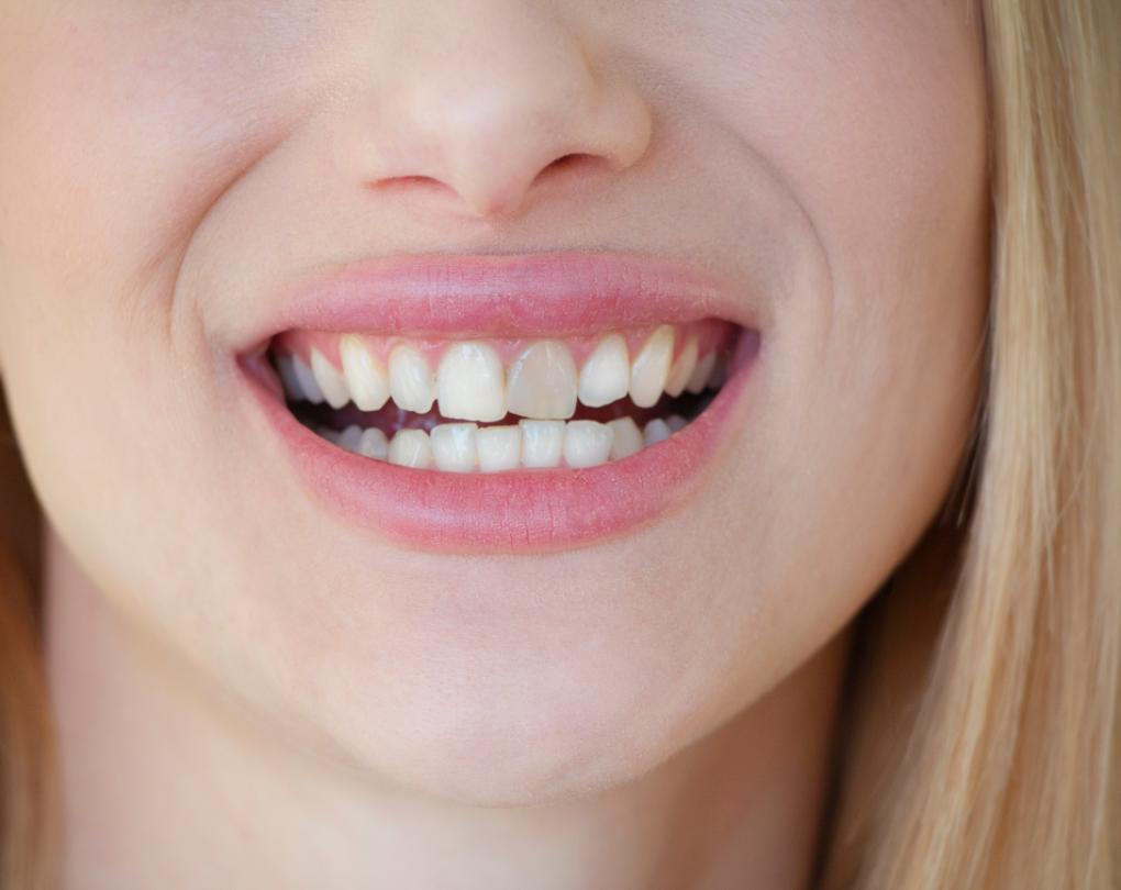 Girl with stained tooth
